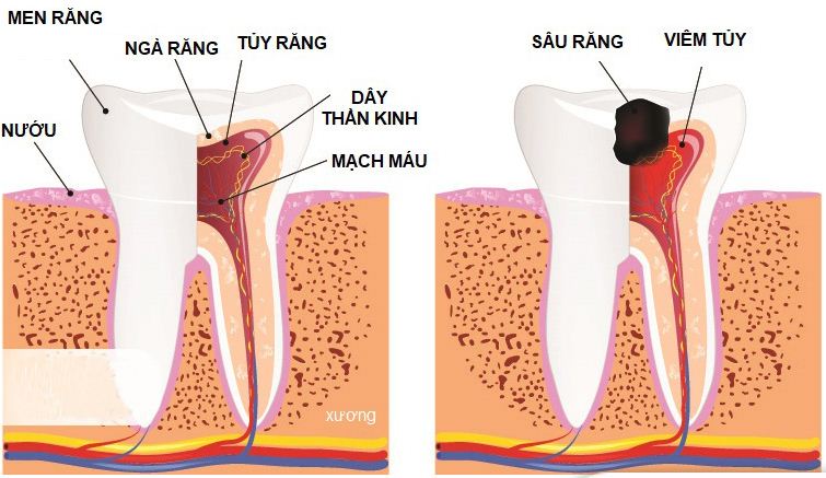 Điều trị tủy răng