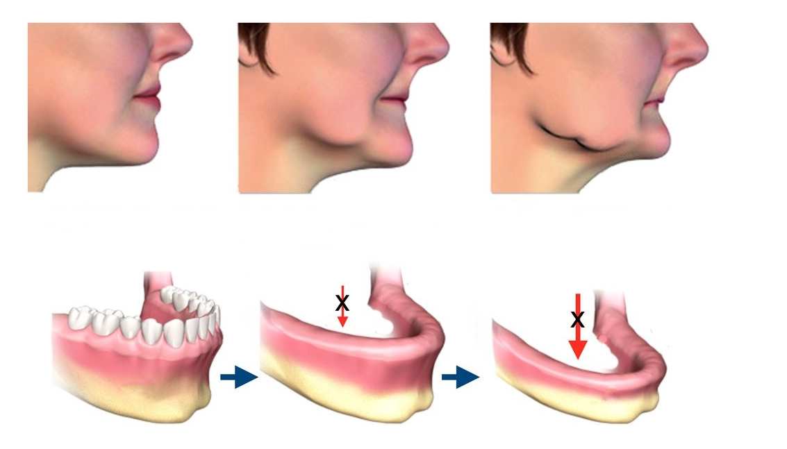 Tiêu xương hàm khiến khuôn mặt bị thay đổi