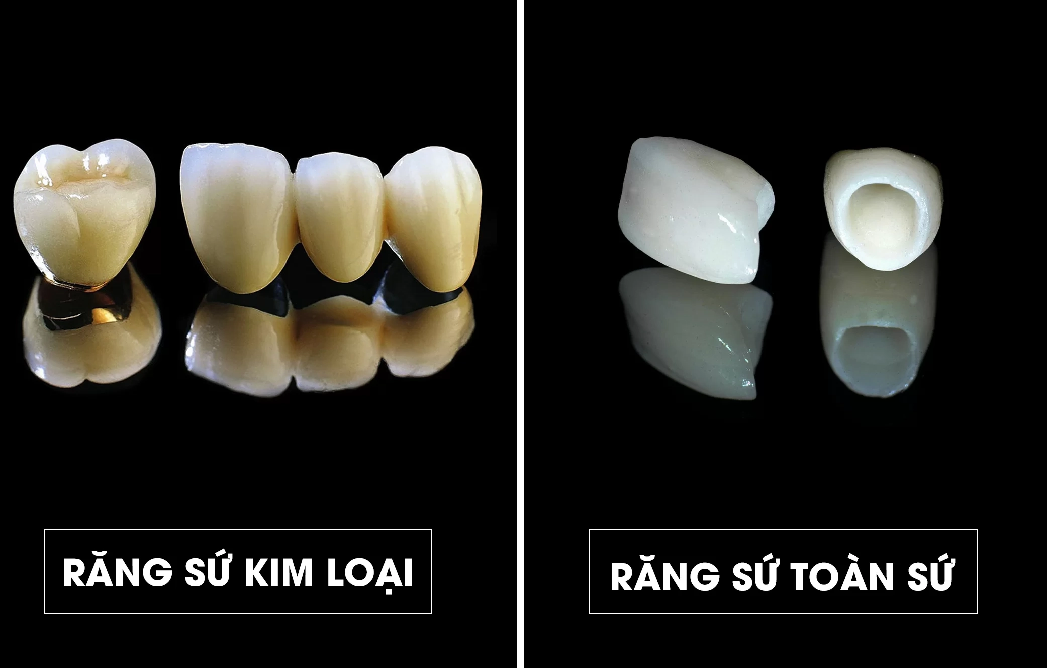 Răng sứ kim loại và răng sứ toàn sứ