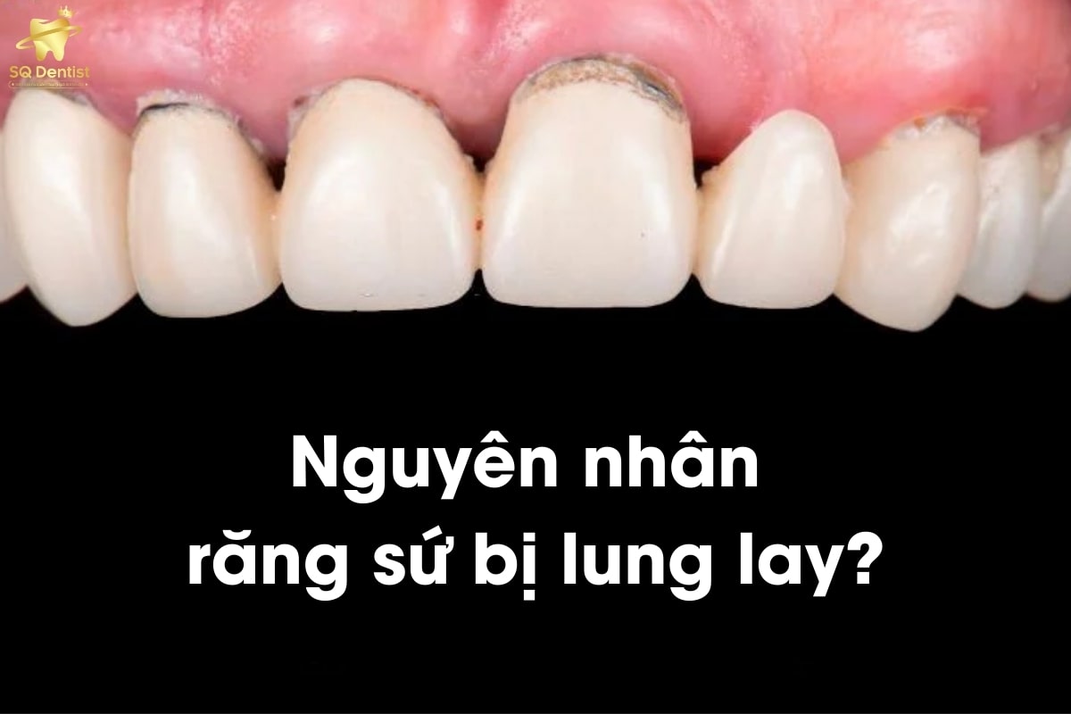 Nguyên nhân răng sứ bị lung lay là gì?