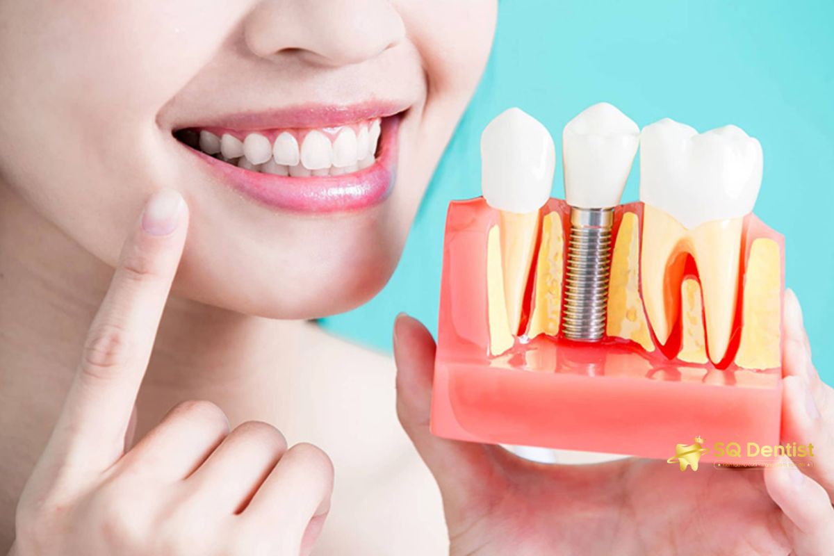 SQ Dentist có thời gian bảo hành tùy theo từng dòng trụ và từng sự cố