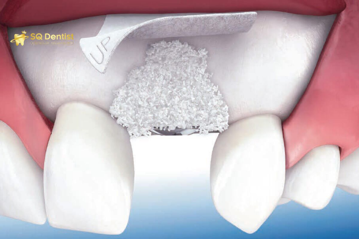 Khi xương hàm bị tiêu biến, mỏng, yếu thì cần ghép xương trước khi cấy ghép implant