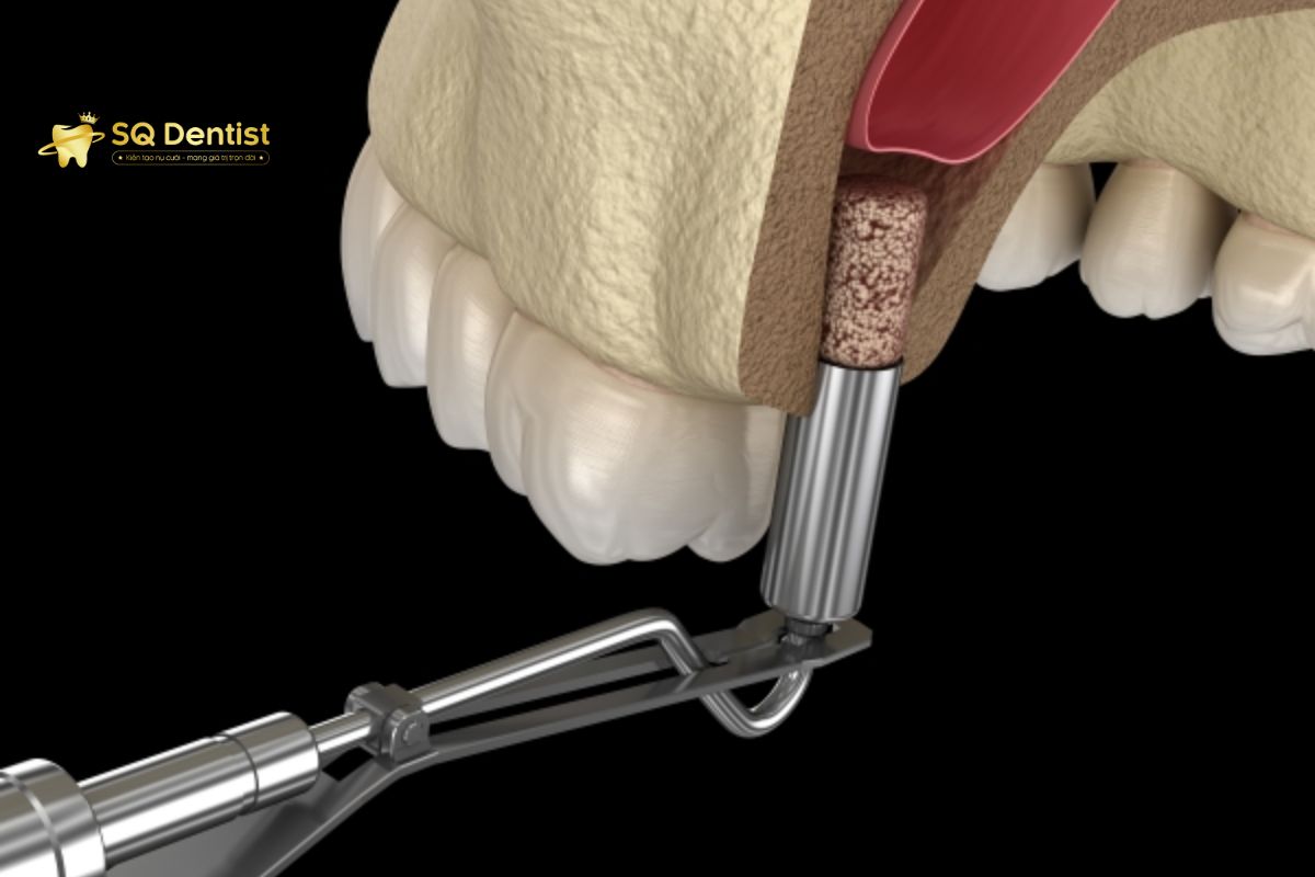 Khi trồng răng implant, nâng xoang sẽ giúp giải quyết tình trạng xương hàm bị tiêu biến, mỏng yếu