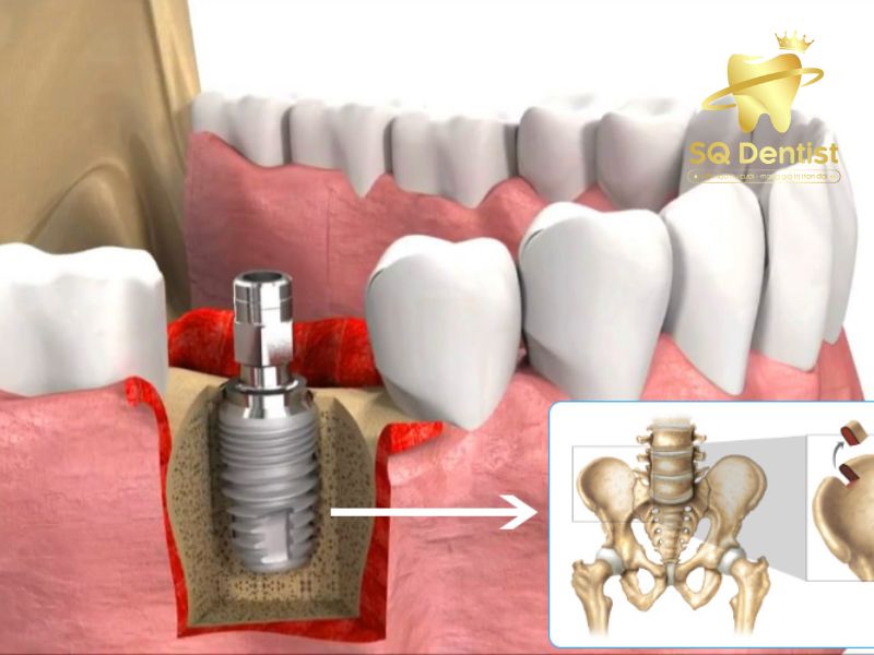 Ghép xương tự thân là phương pháp đưa mảng xương từ bộ phận khác của cơ thể vào vị trí cần ghép