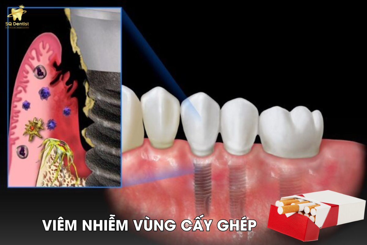 Viêm nhiễm vùng cấy ghép vì hút thuốc lá