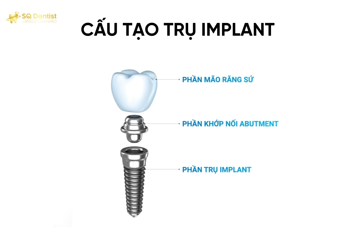 cau-tao-1-tru-implant-hoan-chinh