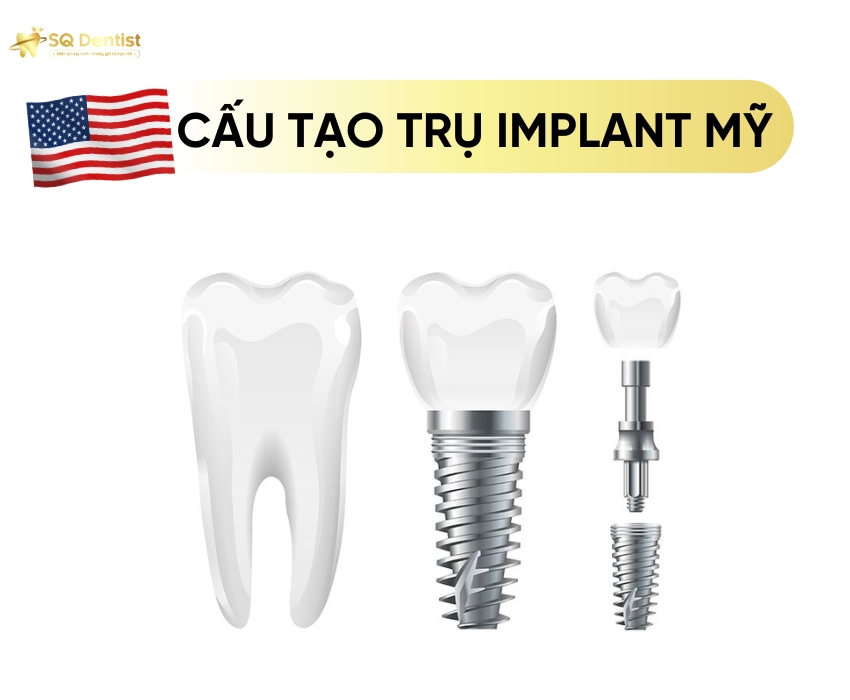 Trụ implant Mỹ nổi bật với chất lượng vượt trội và công nghệ tiên tiến