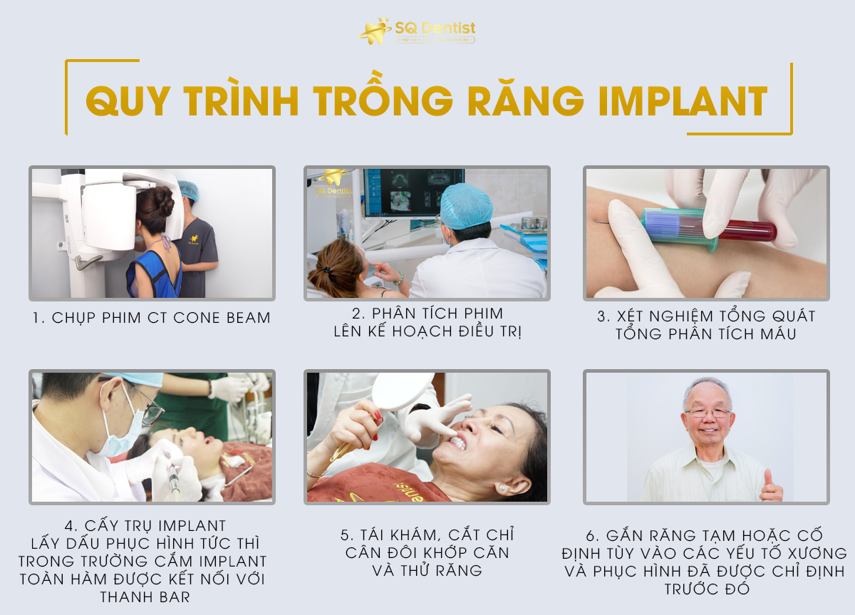 Quy trình trồng răng implant