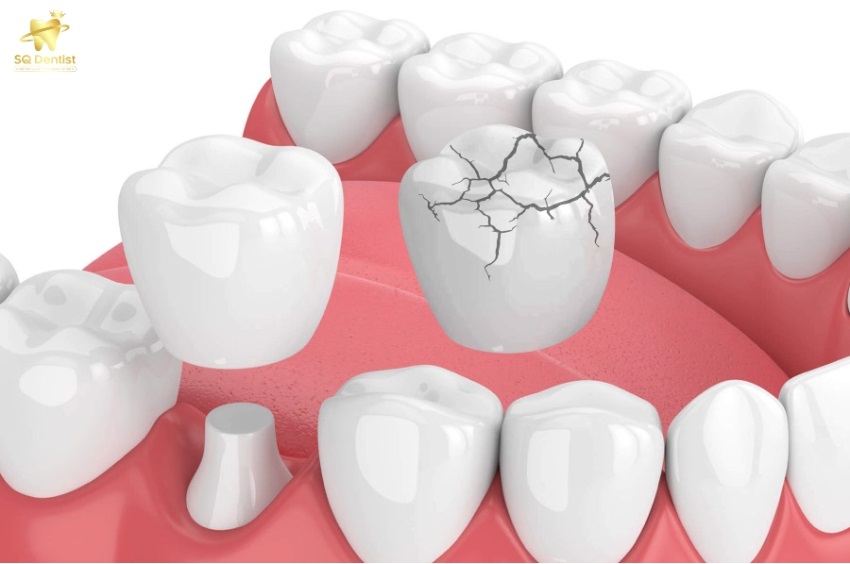 Bọc răng sứ là phương pháp có thể sử dụng khi răng hàm bị vỡ
