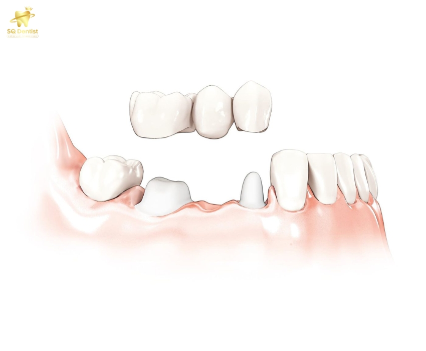 Cầu răng sứ không ngăn được tiêu xương