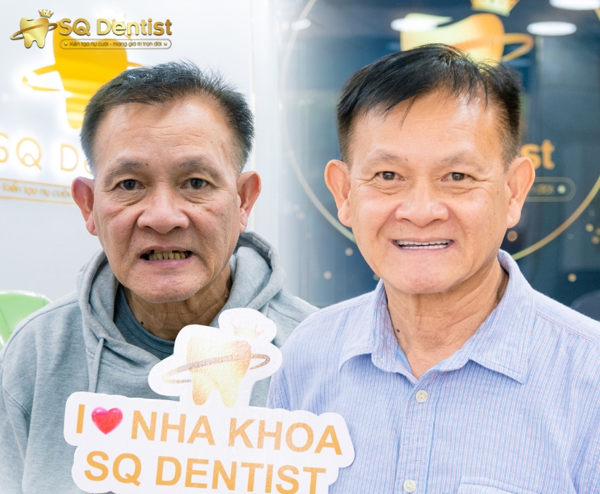 Cấy ghép implant an toàn tại SQ Dentist