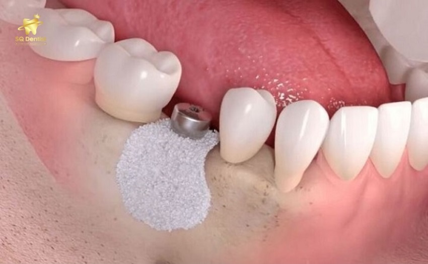 Cấy ghép implant giúp phục hình chân răng toàn diện nhất