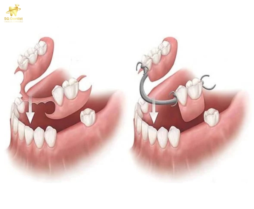 Hàm giả tháo lắp không ngắn được tiêu xương hàm và có tuổi thọ ngắn