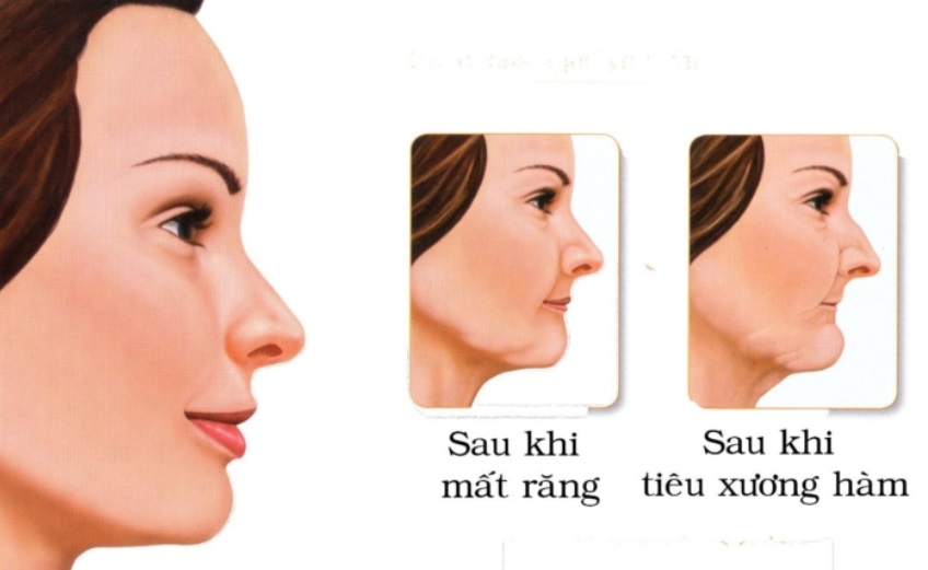 Hậu quả nghiêm trọng khi bị mất chân răng
