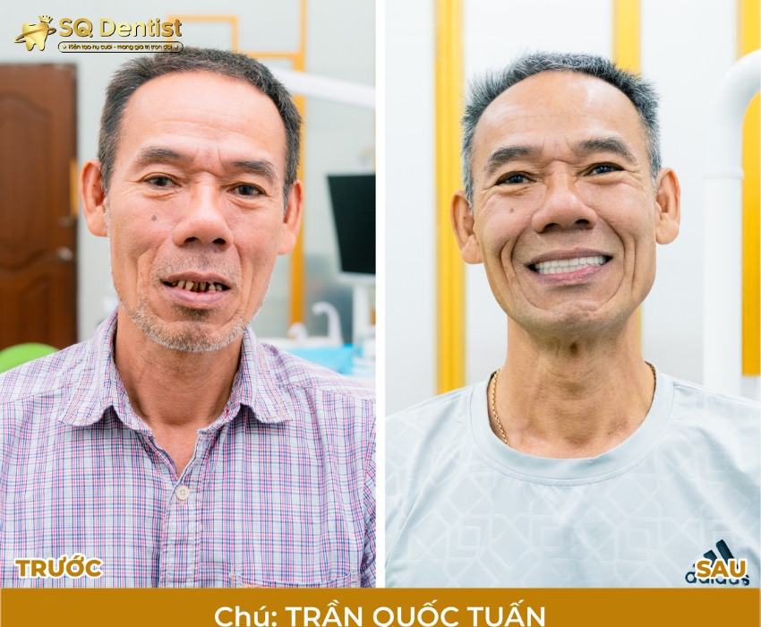 Khách hàng trồng implant tại SQ Dentist thành công