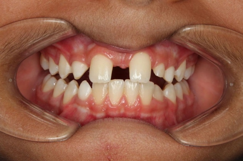 Thiếu răng bẩm sinh ảnh hưởng sự phát triển của xương hàm và răng
