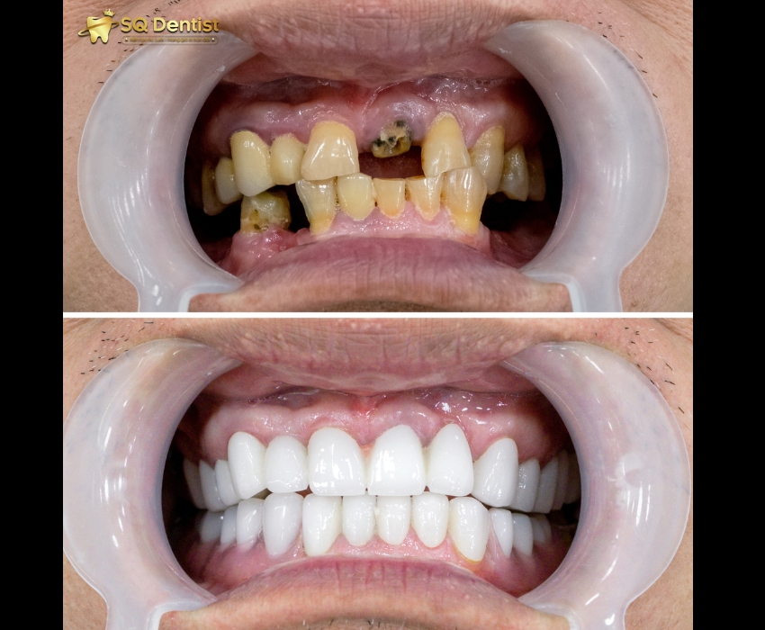 Trồng implant giúp khôi phục chân răng toàn diện