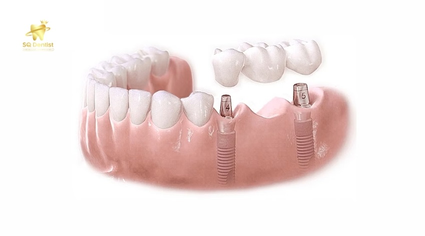Trồng implant khi mất nhiều răng liền kề giúp tiết kiệm chi phí