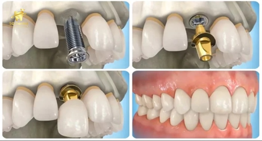 Trồng implant khi mất răng đơn lẻ