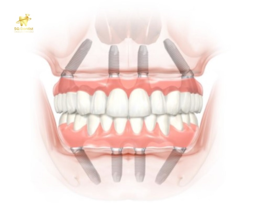 Trồng implant là phương pháp tối ưu nhất khi khi mất răng toàn hàm