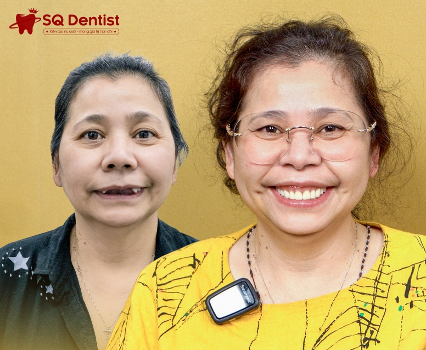 Điều trị răng bị vỡ kịp thời để tránh những biến chứng nguy hiểm