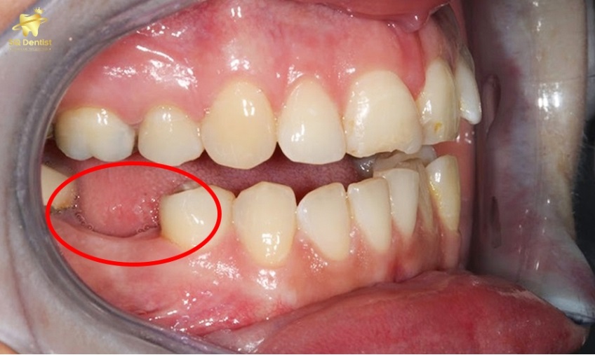 Nguyên nhân gây mất chân răng phổ biến hiện nay