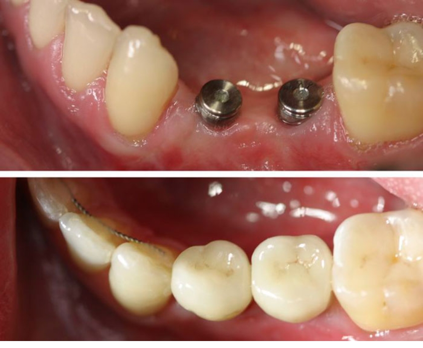 Trường hợp không có mầm răng thì cần cấy implant để bổ sung