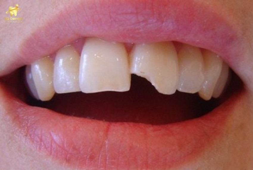 Xác định nguyên nhân vỡ răng là rất quan trọng